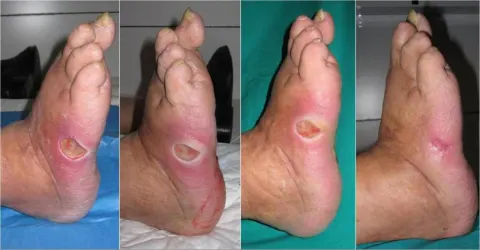 Hình ảnh biến chứng bệnh tiểu đường trên chân