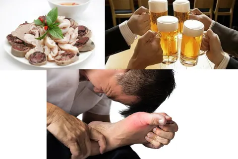 Có thể bạn chưa biết: Thói quen ăn uống không hợp lý sẽ hình thành bệnh gút!