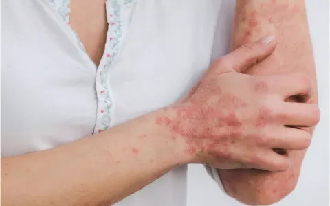 Bệnh vảy nến: Cách nhận biết và điều trị hiệu quả