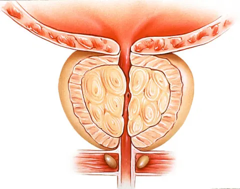 Hình ảnh tuyến tiền liệt phì đại chèn ép vào đường niệu