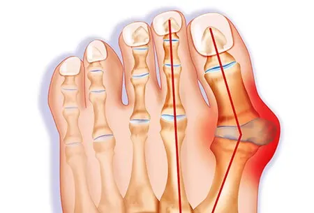 Triệu chứng bệnh gút - làm thế nào để cơn gút cấp không quay trở lại?