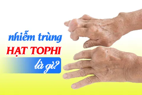 Nhiễm trùng hạt tophi là gì?